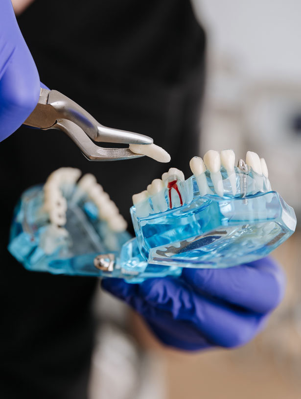Signature Dental Aesthetics - What Are Simple Tooth Extraction