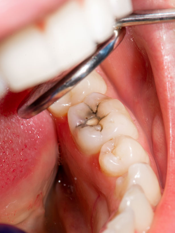 Signature Dental Aesthetics - What Are Tooth Coloured Fillings