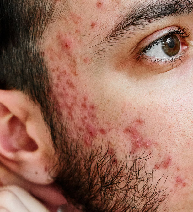 Signature Dental Aesthetics - What Is Acne & Acne Scarring