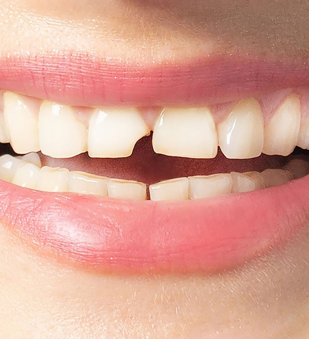 Signature Dental Aesthetics - What Is Broken Teeth