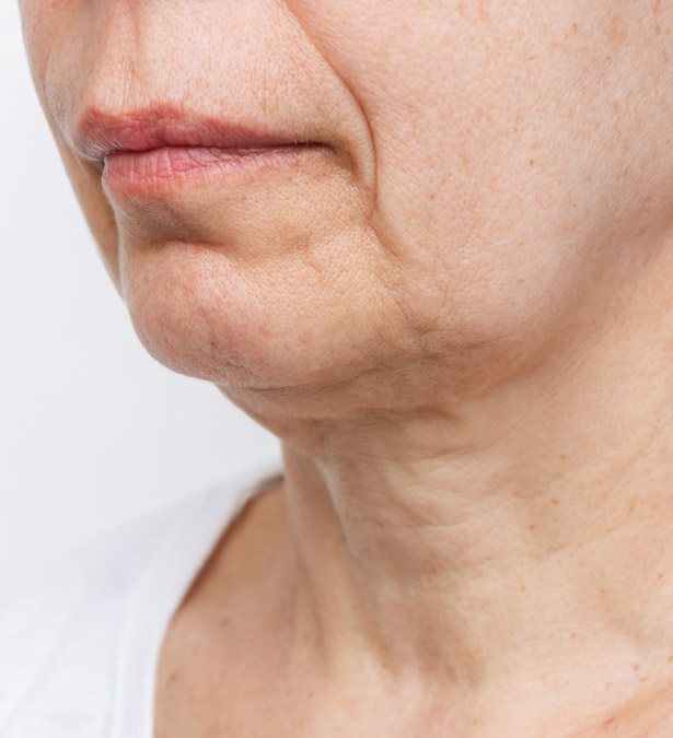Signature Dental Aesthetics - What Is Facial Volume Loss