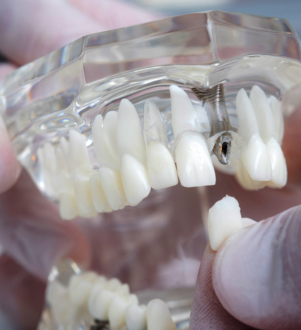 Signature Dental Aesthetics - What Are Failing or Loose Implants
