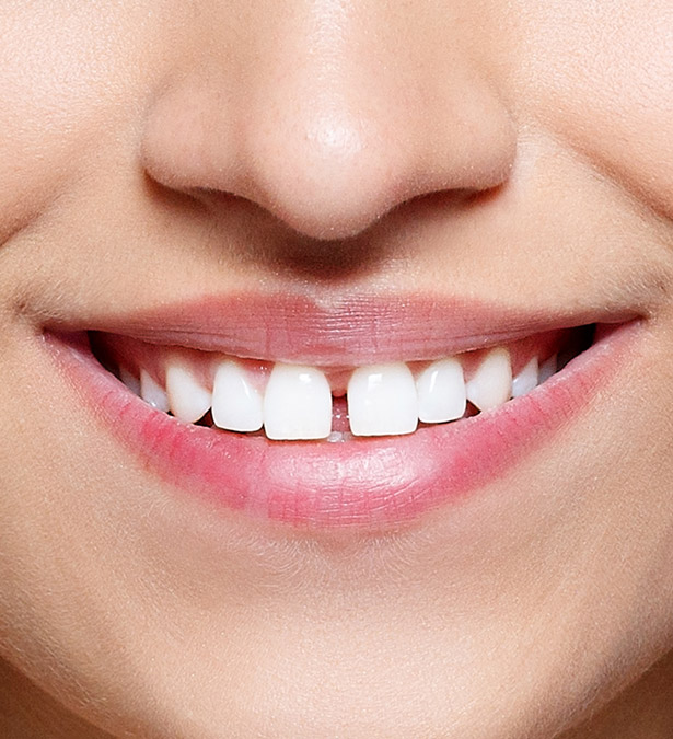 Signature Dental Aesthetics - What Is Gap Teeth
