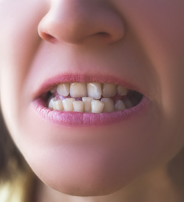 Signature Dental Aesthetics - What Is Misshapen Teeth