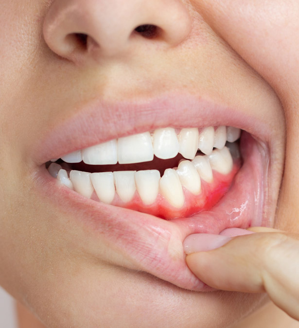 Signature Dental Aesthetics - What Is Peri-implantitis