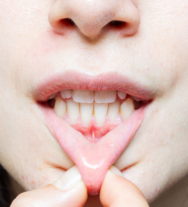 Signature Dental Aesthetics - What Is Receding Gums