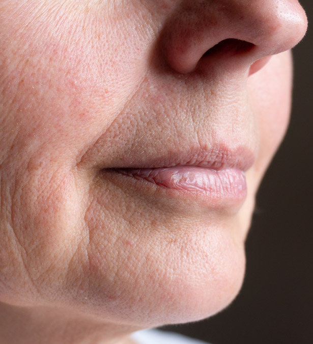 Signature Dental Aesthetics - What Is Skin Laxity