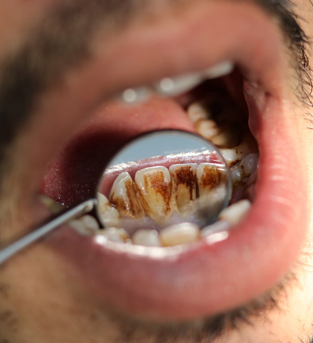Signature Dental Aesthetics - What Is Stained Teeth