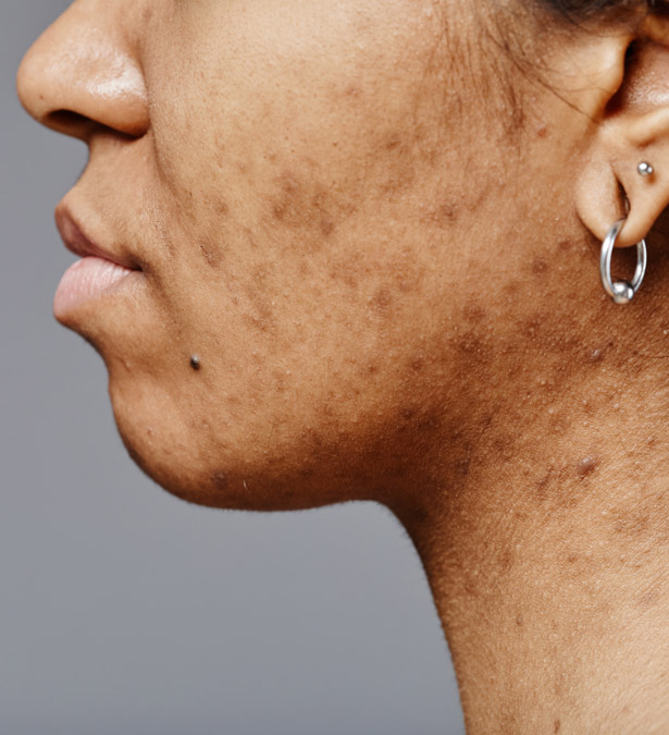 Signature Dental Aesthetics - What Is Sun Damage & Pigmentation