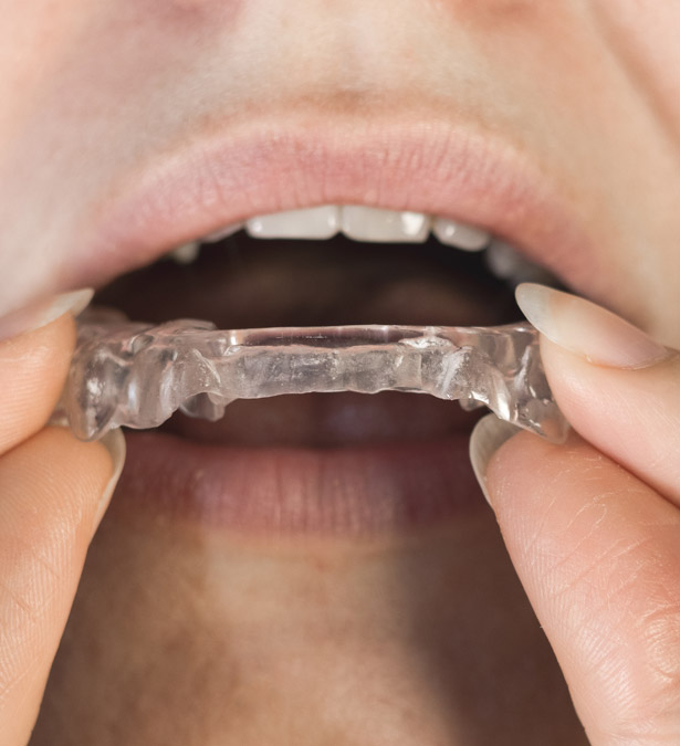 Signature Dental Aesthetics - What Is Teeth Grinding
