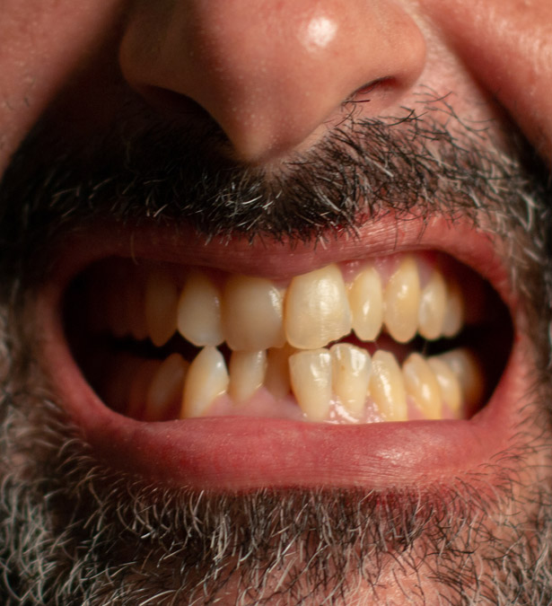 Signature Dental Aesthetics - What Is Worn Teeth