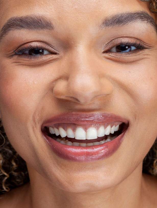 Signature Dental Aesthetics - What is Frenectomy