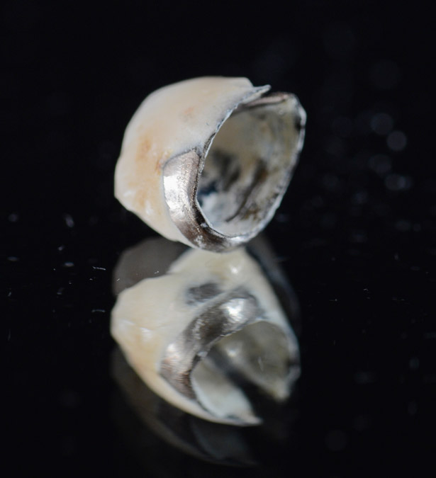 Signature Dental Aesthetics - What Is Need Old Crowns Replaced