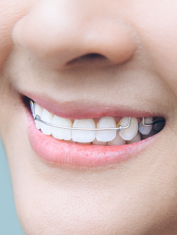 Signature Dental Aesthetics - What is Retainers