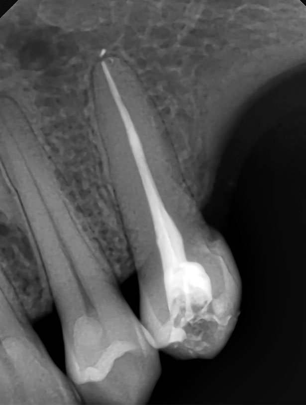 Signature Dental Aesthetics - What is Root Canal Treatment-