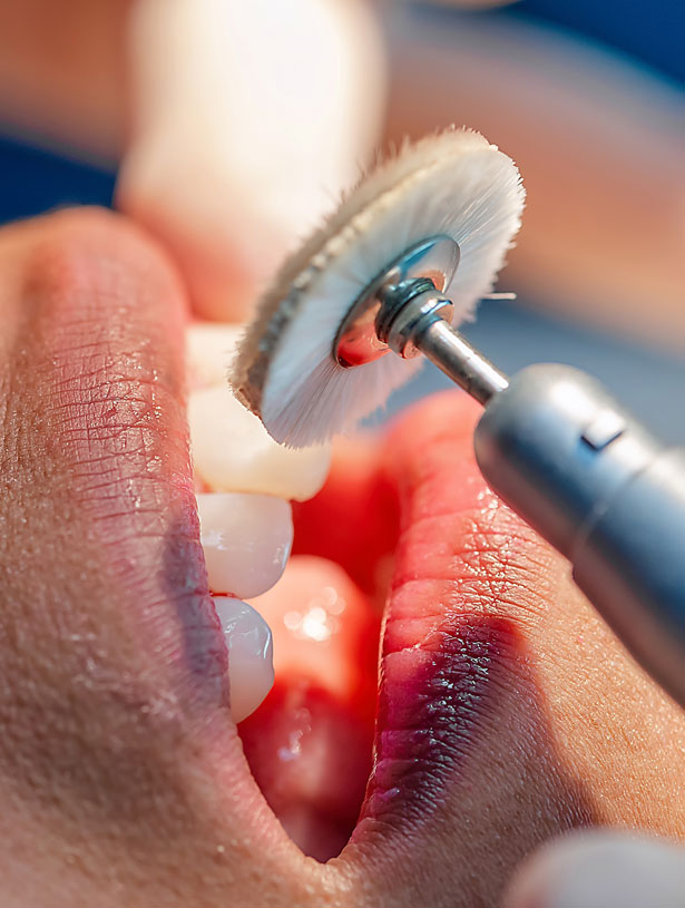 Signature Dental Aesthetics - What is Scale & Polish