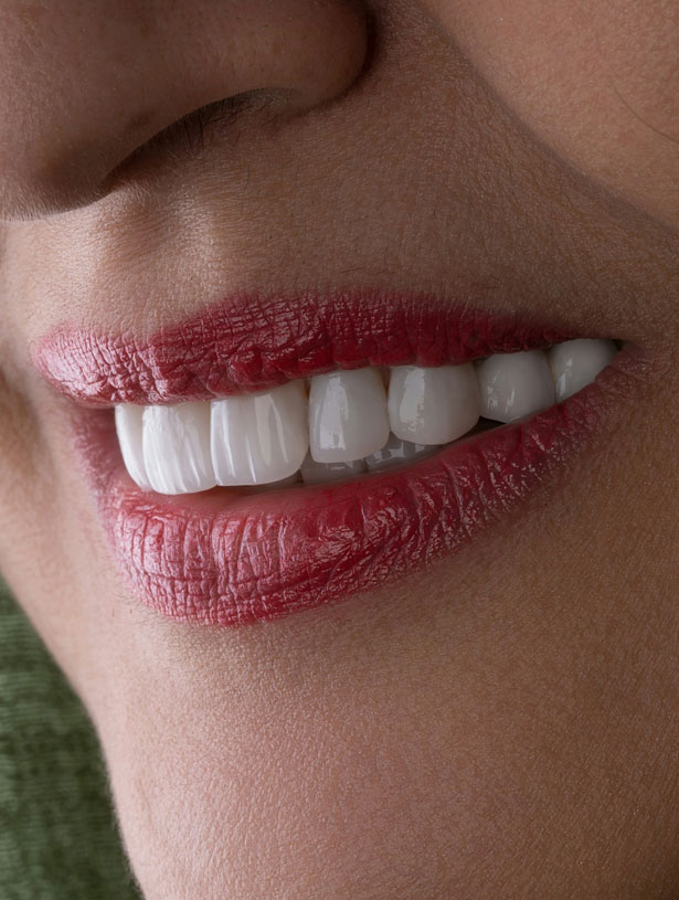 Signature Dental Aesthetics - What is Tooth Whitening