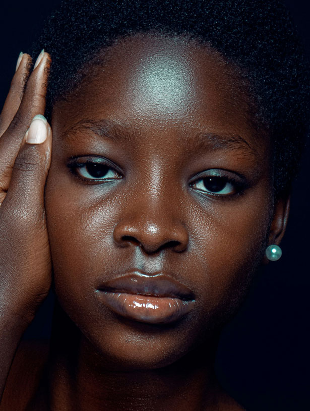 Signature Dental Aesthetics - Why Patients Choose Microneedling (Dermaroller)