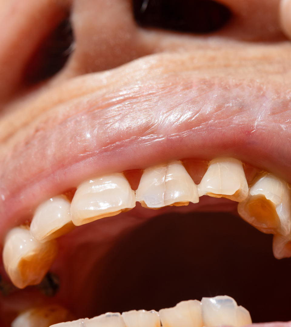 Signature Dental Aesthetics - Worn Teeth