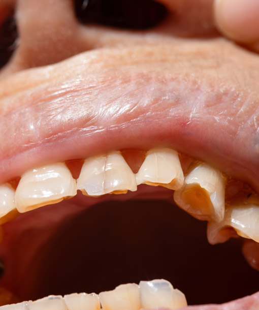 Signature Dental Aesthetics - Worn Teeth